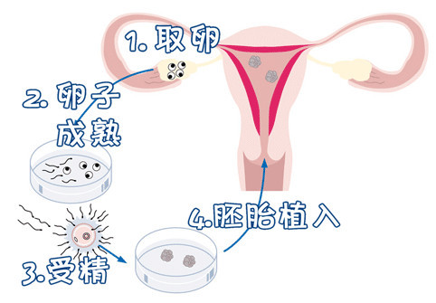 关于找卵代生男孩机构